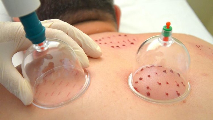 صورة توضيحية للحجامة
